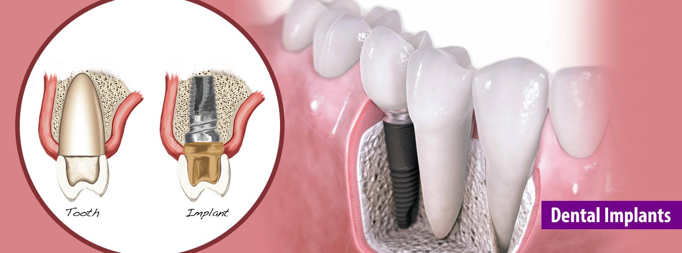 Dental Implant Treatment In Pimple Saudagar Pune