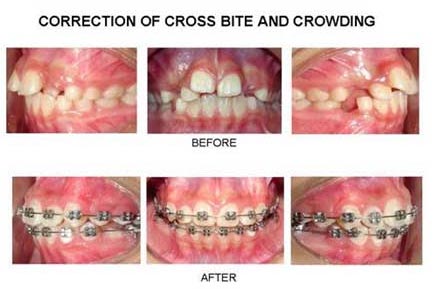 Orthodontic Treatment In Pune