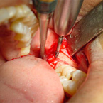 Surgical Extractions and Tooth Removal